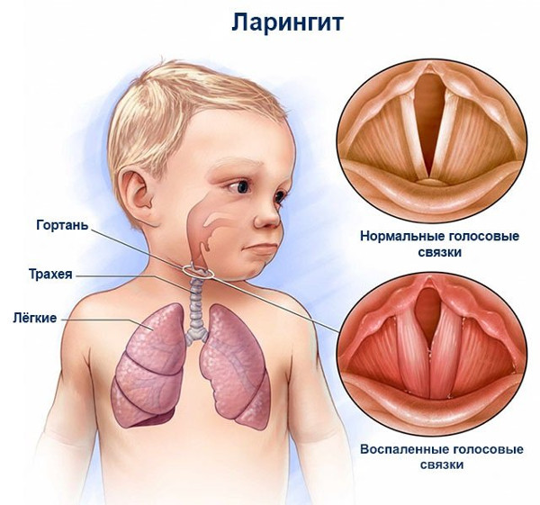 Ларингит после ветрянки