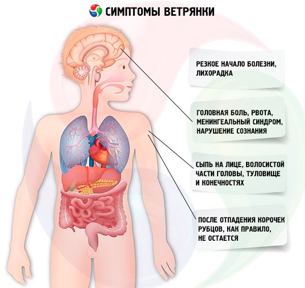 Энцефалит после ветрянки